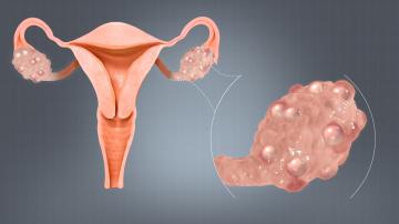 Natural Ways To Balance Blood Sugar in PCOS